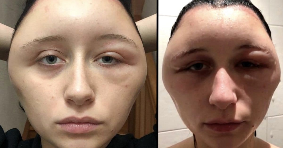 Allergic Reaction To Hair Dye Causes Womans Head To Double In Size